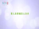 婴儿血管瘤怎么治好